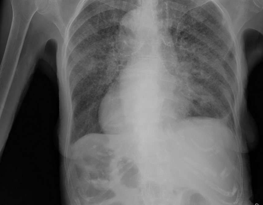 What you Should Know About TB