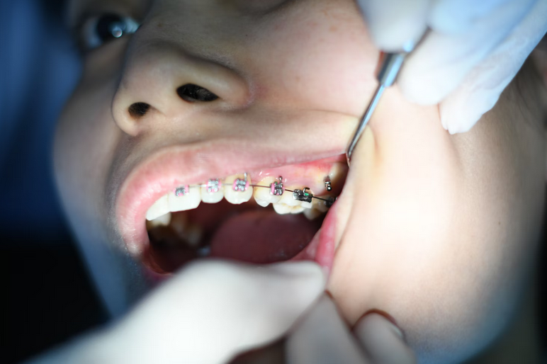 How to Prepare Your Child for Braces